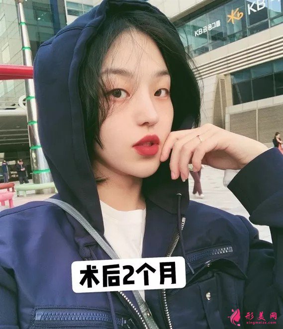 李信锋做鼻子怎么样?看看案例图就知道医生技术了