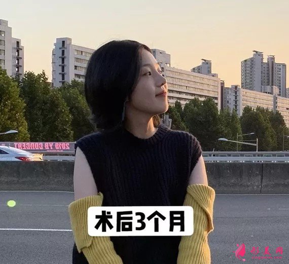李信锋做鼻子怎么样?看看案例图就知道医生技术了