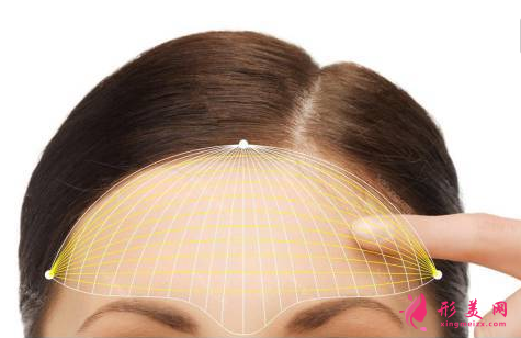 玻尿酸丰额头要多久消肿