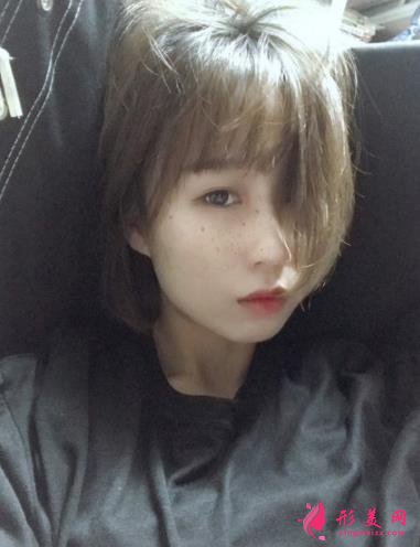 新反馈!深圳博爱医院整形美容科祛斑案例~