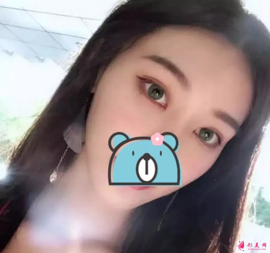 深圳阳光医院双眼皮案例,单眼皮妹子的完美逆袭