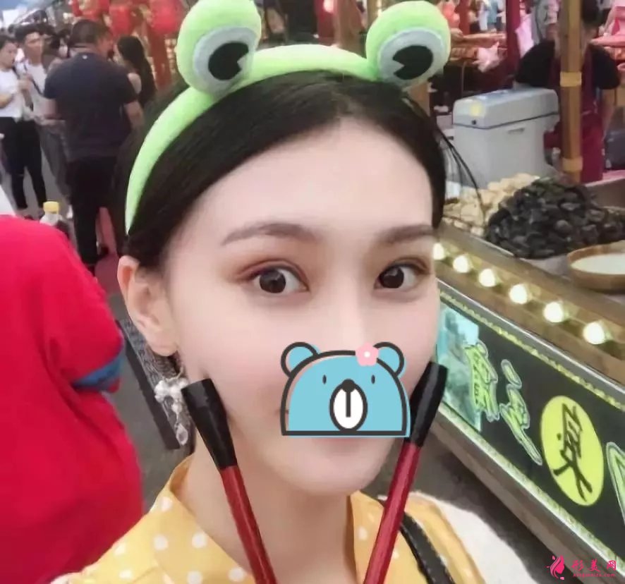 深圳阳光医院双眼皮案例,单眼皮妹子的完美逆袭