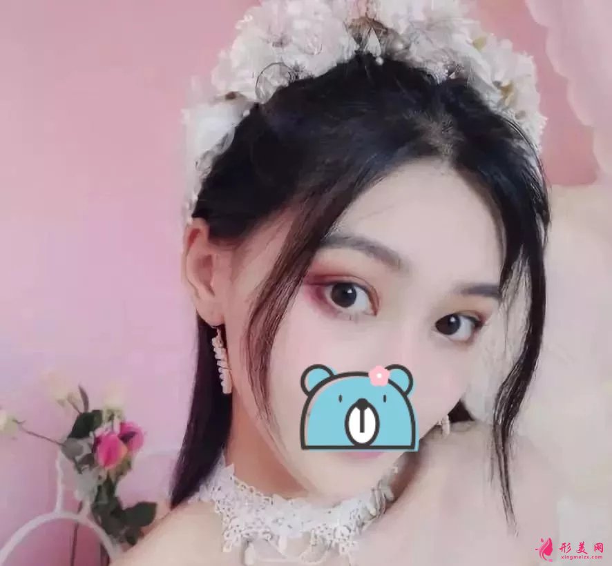 深圳阳光医院双眼皮案例,单眼皮妹子的完美逆袭