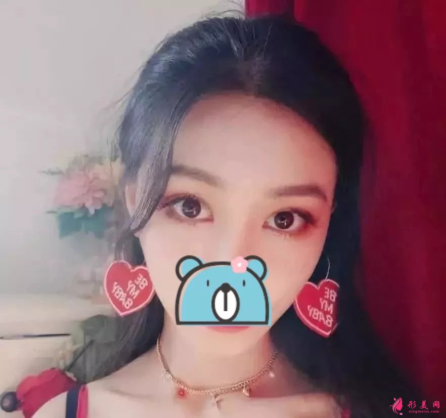 深圳阳光医院双眼皮案例,单眼皮妹子的完美逆袭