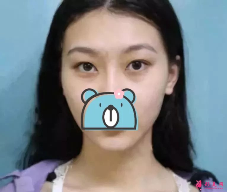 深圳阳光医院双眼皮案例,单眼皮妹子的完美逆袭