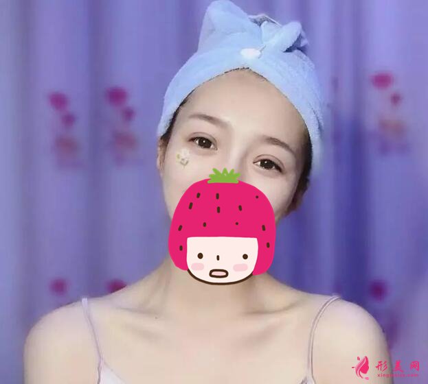 深圳美莱梁志为双眼皮案例,做个双眼皮“改头换面”