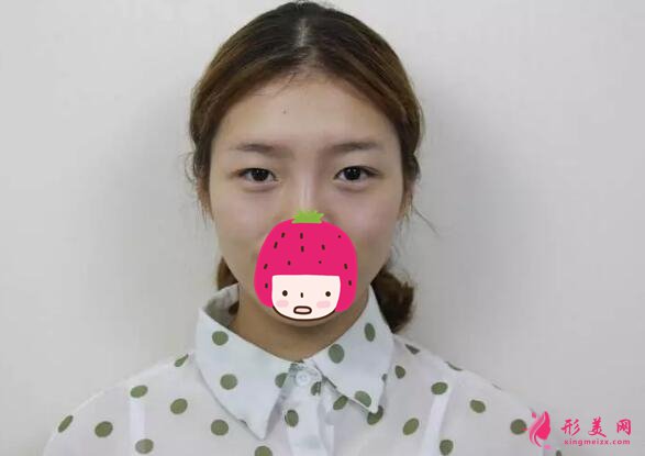 深圳美莱梁志为双眼皮案例,做个双眼皮“改头换面”