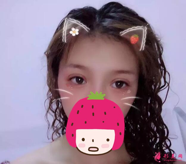 深圳美莱梁志为双眼皮案例,做个双眼皮“改头换面”