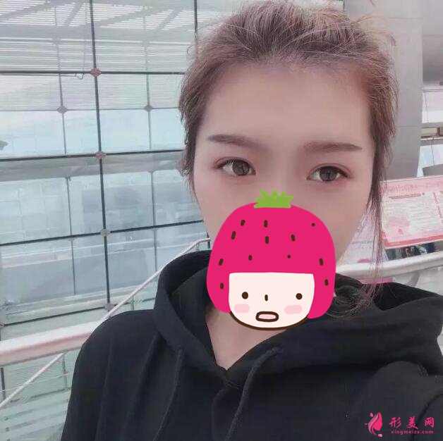 深圳美莱梁志为双眼皮案例,做个双眼皮“改头换面”