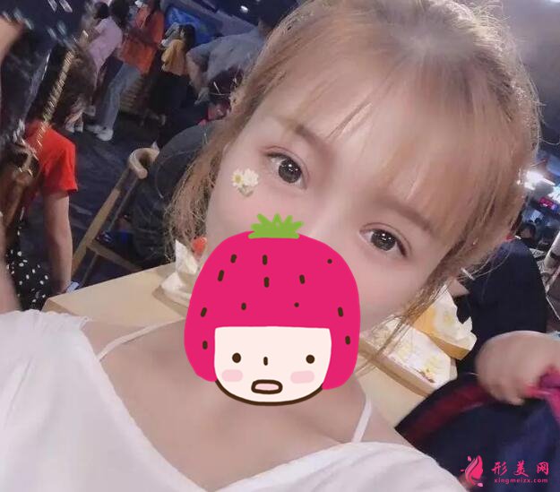 深圳美莱梁志为双眼皮案例,做个双眼皮“改头换面”