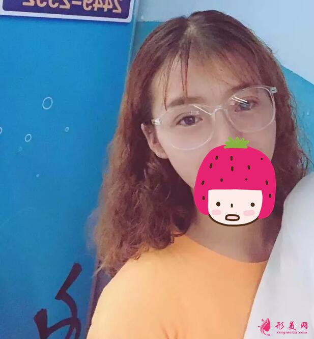 深圳美莱梁志为双眼皮案例,做个双眼皮“改头换面”