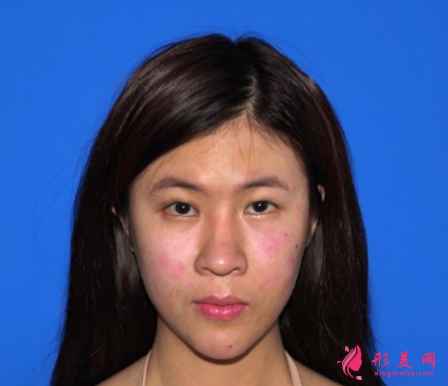 北医三院闫爱萍为我做的双眼皮 术后60天效果恢复实在是太自然了