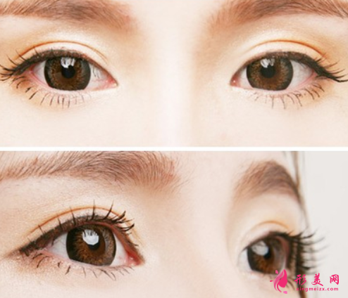 切开双眼皮术后不能吃什么