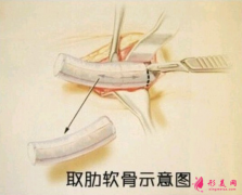 肋软骨隆鼻以后要更换吗