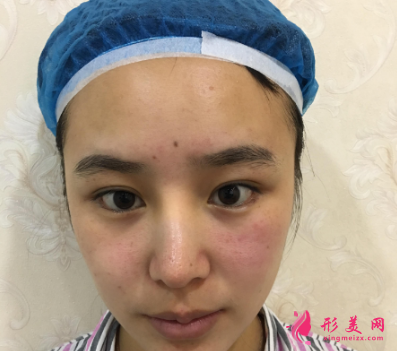 北医三院马勇光做双眼皮怎么样?30天术后恢复效果真的非常不错