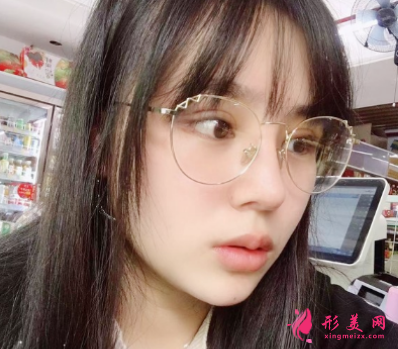 北医三院马勇光做双眼皮怎么样?30天术后恢复效果真的非常不错