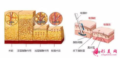 吸脂手术简介