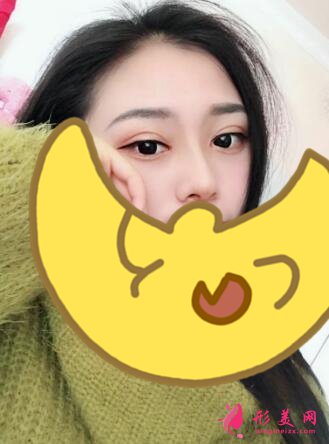 深圳罗金刚双眼皮案例,术后变化就是这么大!