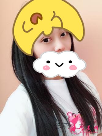 深圳罗金刚双眼皮案例,术后变化就是这么大!