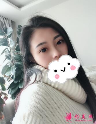 深圳罗金刚双眼皮案例,术后变化就是这么大!