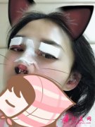 深圳罗金刚双眼皮怎么样？，双眼皮术后分享，变化就是这么大！