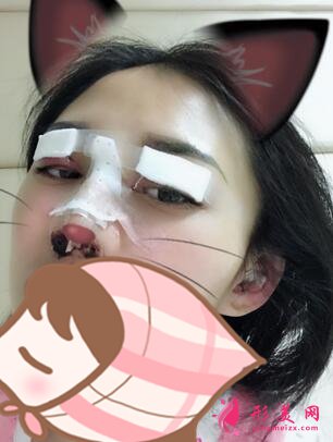 深圳罗金刚双眼皮案例,术后变化就是这么大!