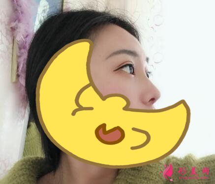 深圳罗金刚双眼皮案例,术后变化就是这么大!