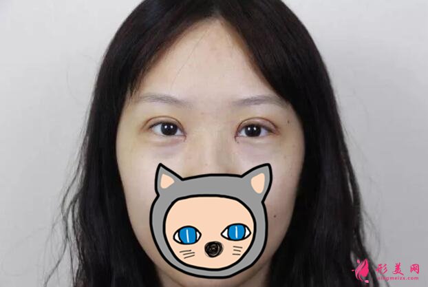 深圳叶琳双眼皮案例,把小姐姐的美分享给大家