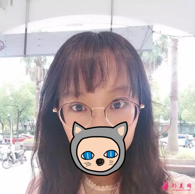 深圳叶琳双眼皮案例,把小姐姐的美分享给大家