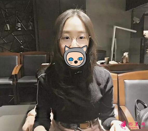 深圳叶琳双眼皮案例,把小姐姐的美分享给大家