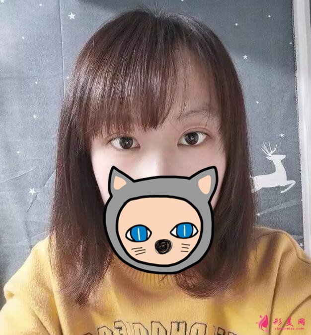 深圳叶琳双眼皮案例,把小姐姐的美分享给大家