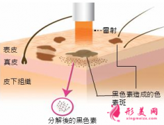 激光祛斑对皮肤有损伤吗？