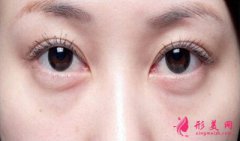吸脂祛眼袋手术安全吗？