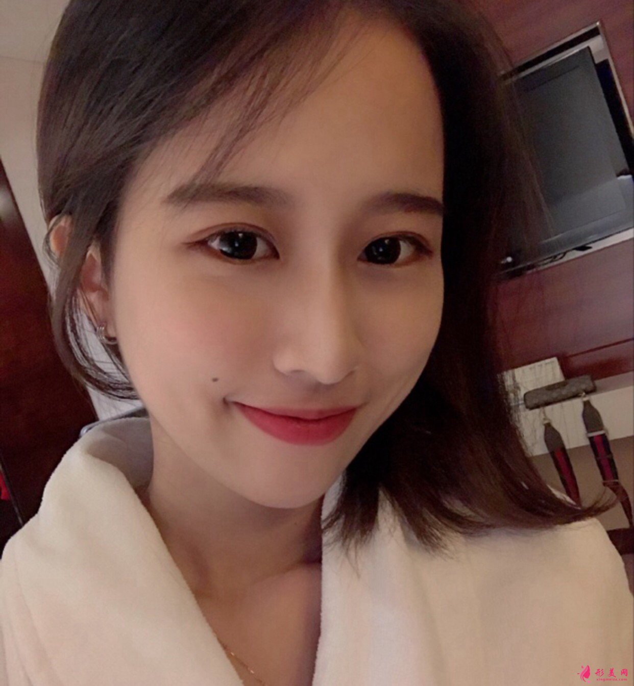 杭州格莱美汤颖峰医生双眼皮修复+鼻修复+假体下颏 案例分享