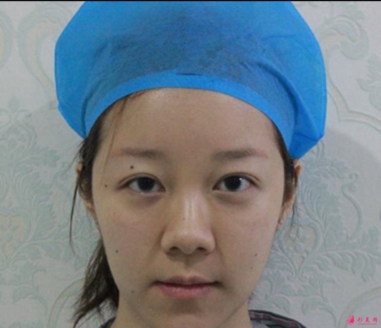 杭州格莱美汤颖峰医生双眼皮修复+鼻修复+假体下颏 案例分享