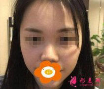 深圳欧亚美医疗美容怎么样？口碑好不好？隆鼻案例分享