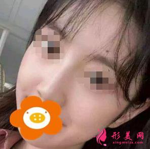 隆鼻三个月后恢复效果很好,鼻子形态自然无痕