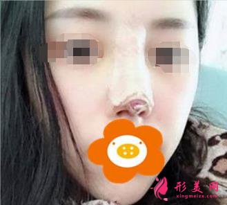隆鼻三个月后恢复效果很好,鼻子形态自然无痕