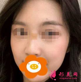 隆鼻三个月后恢复效果很好,鼻子形态自然无痕