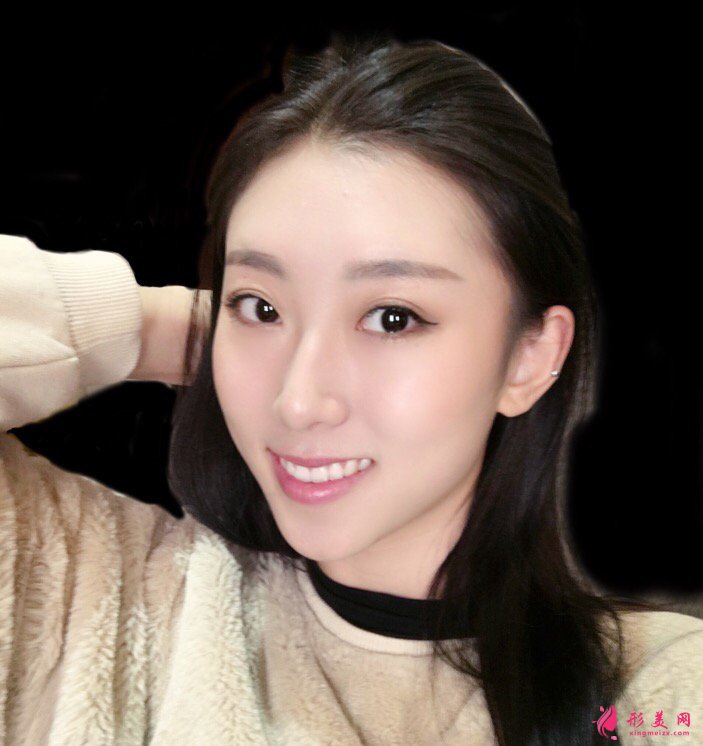 西安美立方李旭平医师真人隆鼻案例 35天前后对比图分享