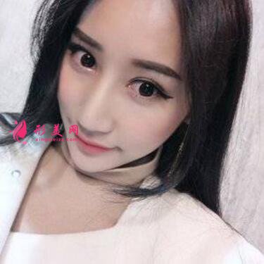 感受田永成双眼皮技术的精细效果怎么样,真实案例照片