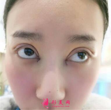 感受田永成双眼皮技术的精细效果怎么样,真实案例照片