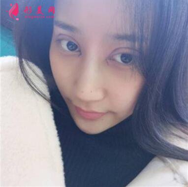 感受田永成双眼皮技术的精细效果怎么样,真实案例照片