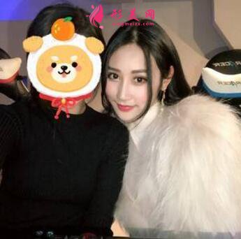 感受田永成双眼皮技术的精细效果怎么样,真实案例照片