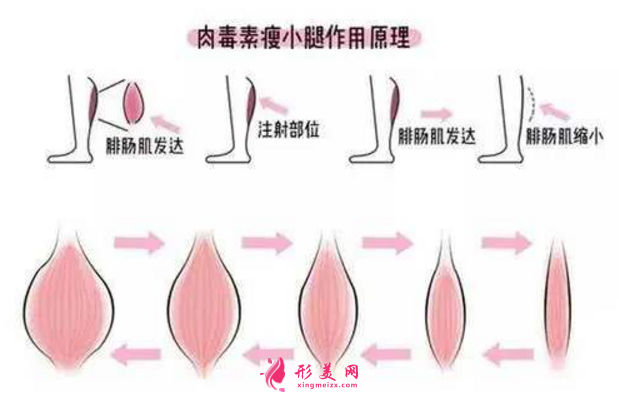 注射瘦腿针1个月,谈谈效果