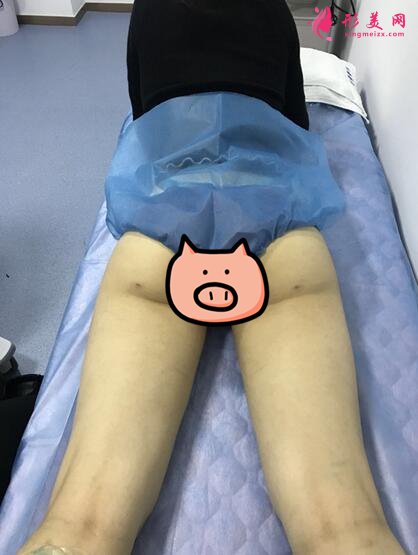 深圳鹏爱整形医院大腿吸脂术案例
