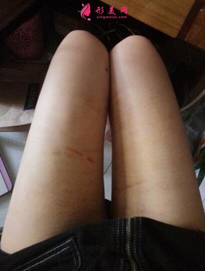 深圳鹏爱整形医院大腿吸脂术案例