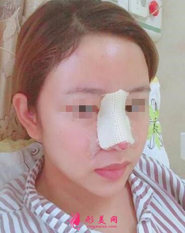 鼻子做假体已经5个月了