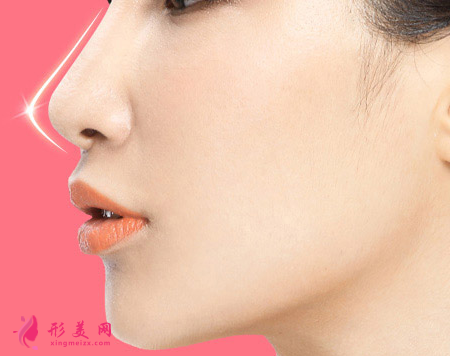 假体隆鼻后侧睡会歪吗