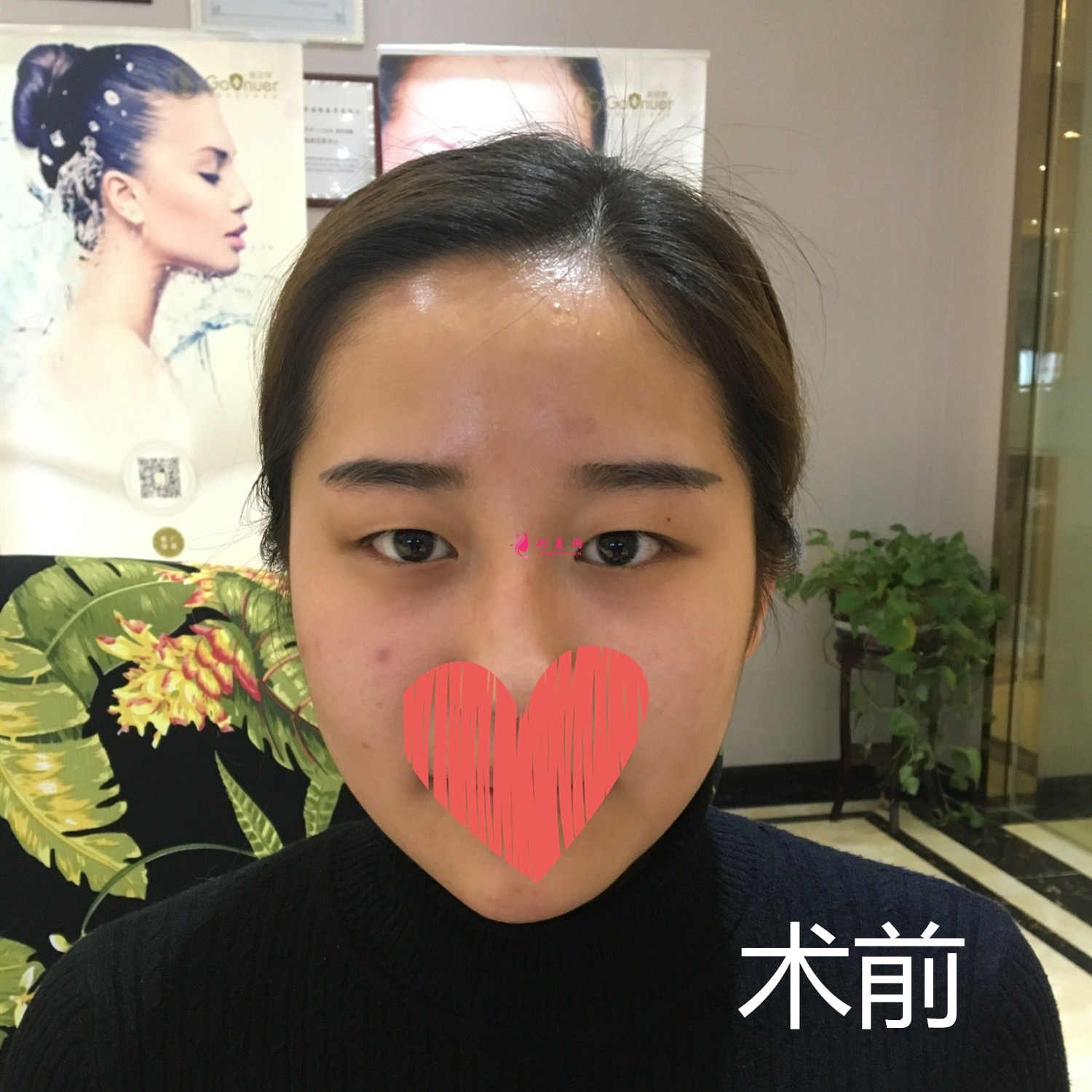 北京双眼皮修复:魏志香医生